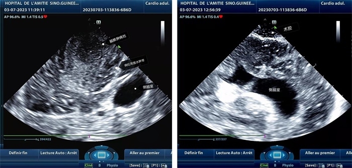 左圖顯示術(shù)中超聲見囊實(shí)性病變，大小約為4x4x3cm，病灶周圍腦組織水腫明顯；右圖為病灶切除后，術(shù)中超聲示術(shù)腔無病變殘留