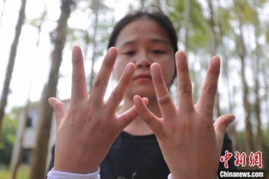 吳素英展示被蜜蜂蜇過的雙手。湯曉逵 攝