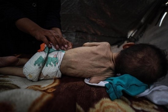 這是5月28日在加沙城西部一處臨時安置點拍攝的一名營養(yǎng)不良的嬰兒。新華社發(fā)（馬哈茂德·扎基攝）